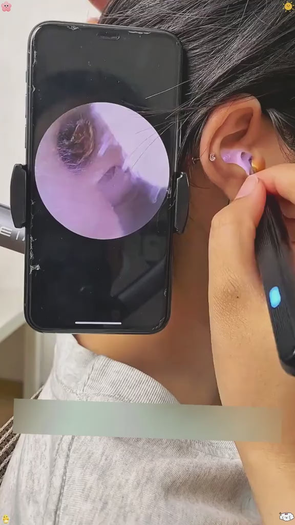Ear Wax Removal Tool with 12MP Camera